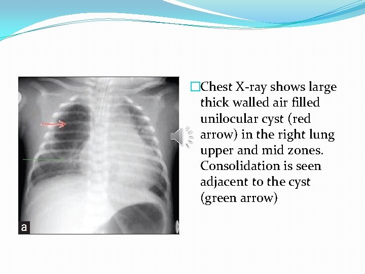 �Chest X-ray shows large thick walled air filled unilocular cyst (red arrow) in the