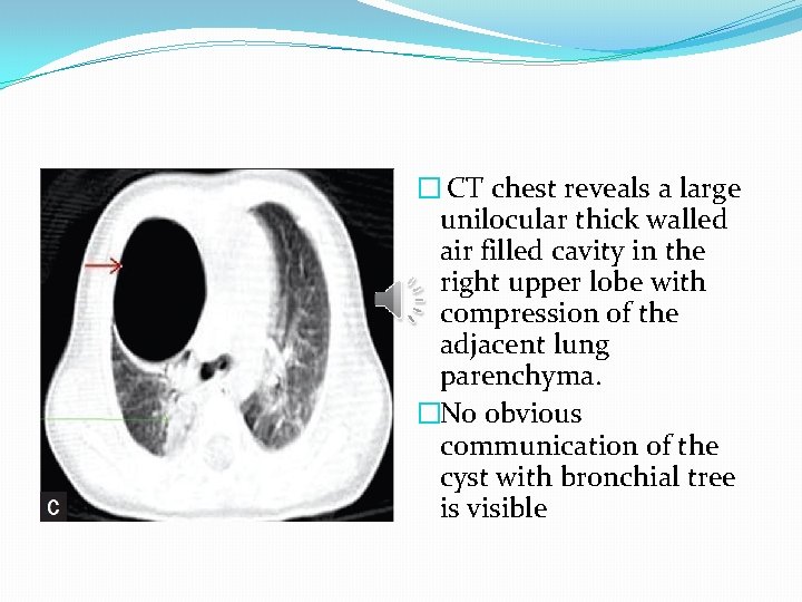 � CT chest reveals a large unilocular thick walled air filled cavity in the