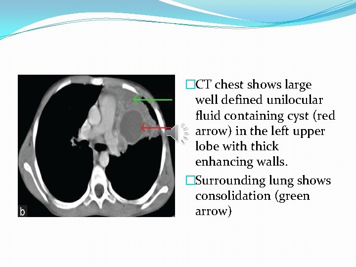 �CT chest shows large well defined unilocular fluid containing cyst (red arrow) in the