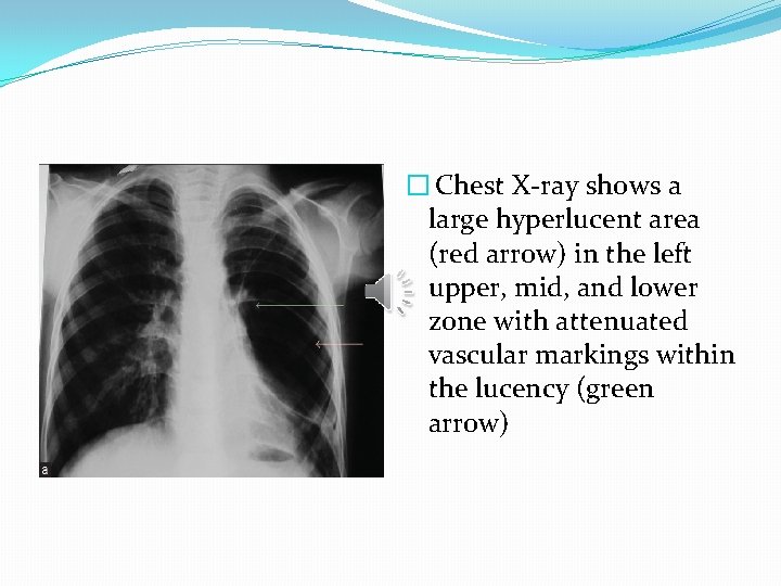 � Chest X-ray shows a large hyperlucent area (red arrow) in the left upper,