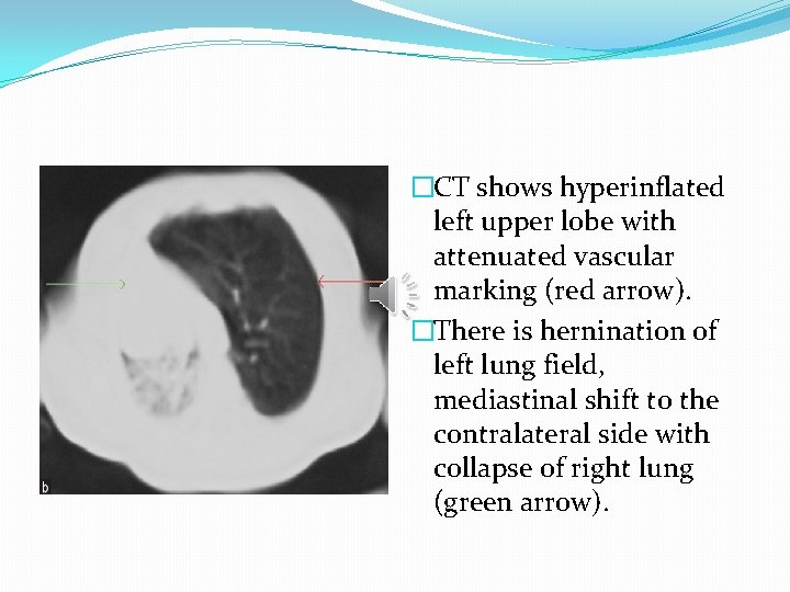 �CT shows hyperinflated left upper lobe with attenuated vascular marking (red arrow). �There is