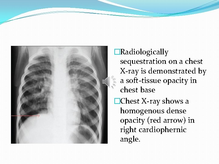 �Radiologically sequestration on a chest X-ray is demonstrated by a soft-tissue opacity in chest