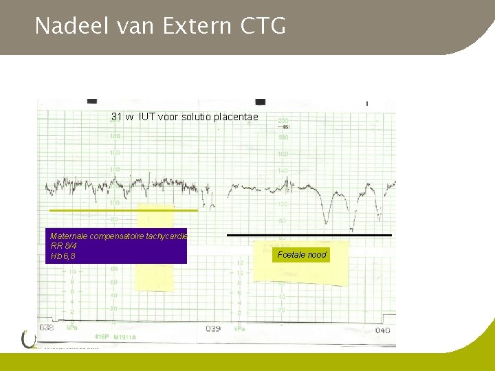 Nadeel van Extern CTG 31 w IUT voor solutio placentae Maternale compensatoire tachycardie RR