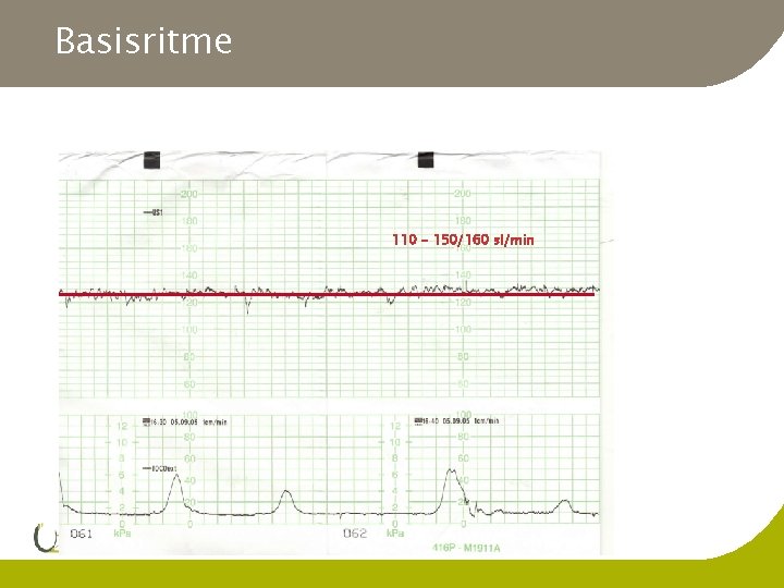 Basisritme 110 - 150/160 sl/min 