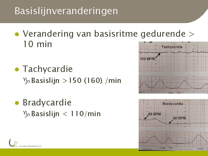 Basislijnveranderingen l l Verandering van basisritme gedurende > 10 min Tachycardie g Basislijn >150