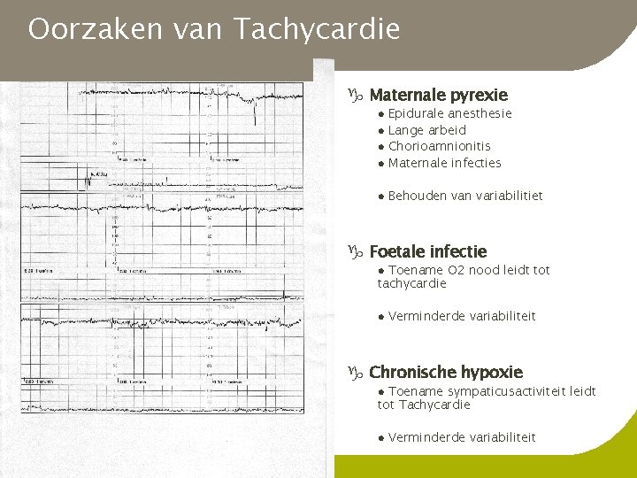 Oorzaken van Tachycardie g Maternale pyrexie l Epidurale anesthesie Lange arbeid Chorioamnionitis Maternale infecties