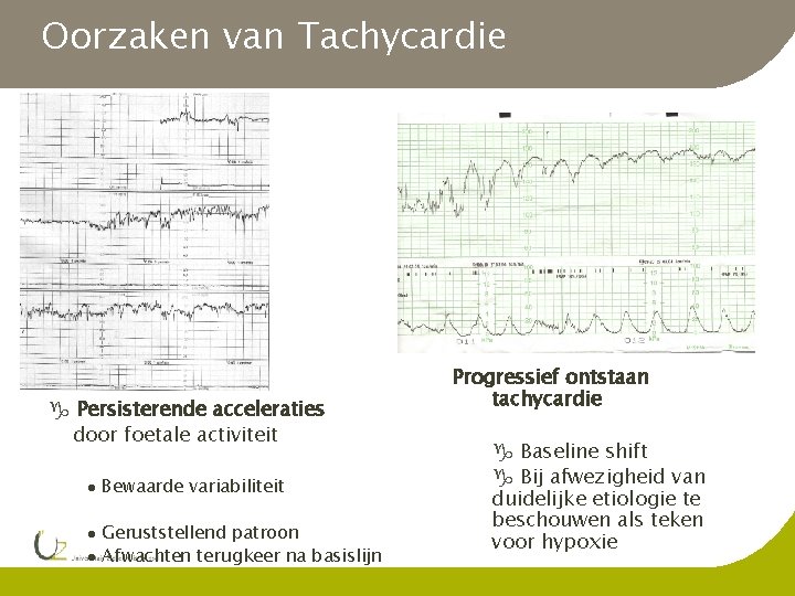 Oorzaken van Tachycardie g Persisterende acceleraties door foetale activiteit l l l Bewaarde variabiliteit