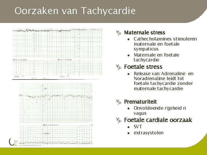 Oorzaken van Tachycardie g Maternale stress l l Cathecholamines stimuleren maternale en foetale sympaticus