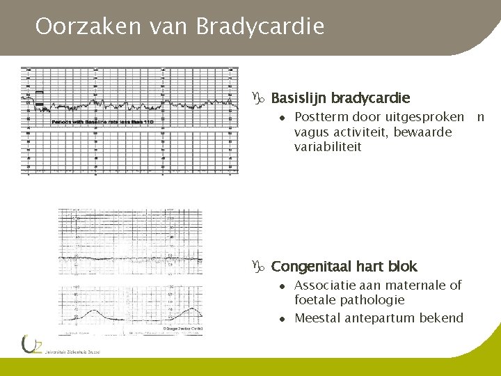 Oorzaken van Bradycardie g Basislijn bradycardie l Postterm door uitgesproken n vagus activiteit, bewaarde