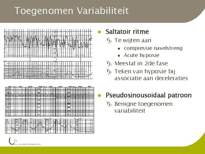 Toegenomen Variabiliteit l Saltatoir ritme g Te wijten aan l l compressie navelstreng Acute