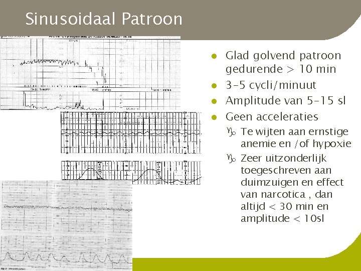 Sinusoidaal Patroon l l Glad golvend patroon gedurende > 10 min 3 -5 cycli/minuut