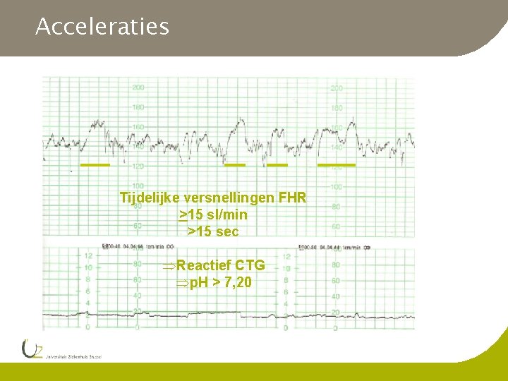 Acceleraties Tijdelijke versnellingen FHR >15 sl/min >15 sec Reactief CTG p. H > 7,