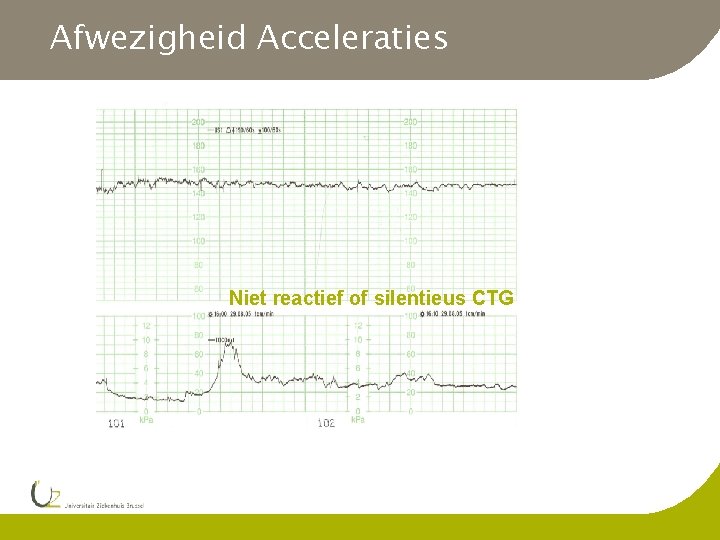 Afwezigheid Acceleraties Niet reactief of silentieus CTG 