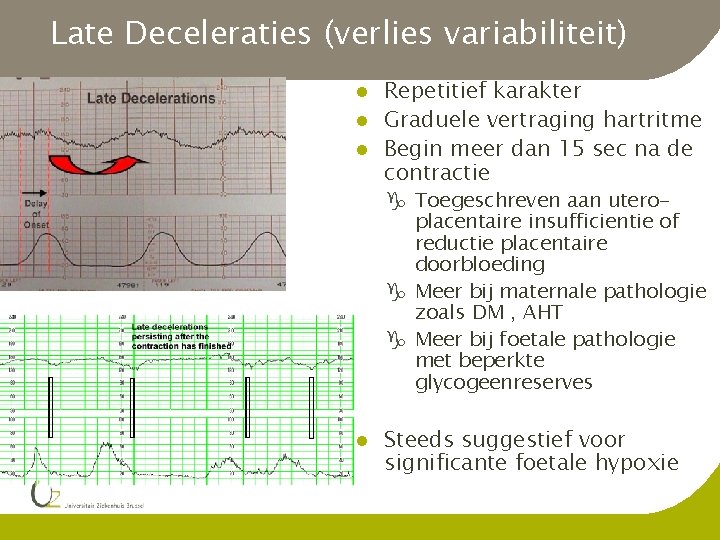 Late Deceleraties (verlies variabiliteit) l l l Repetitief karakter Graduele vertraging hartritme Begin meer