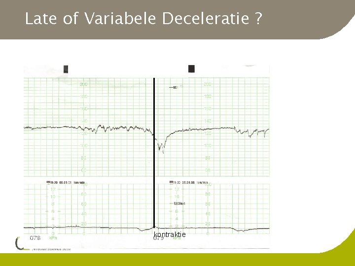 Late of Variabele Deceleratie ? 29 w IUGR/ernstige pre-eclampsie kontraktie 