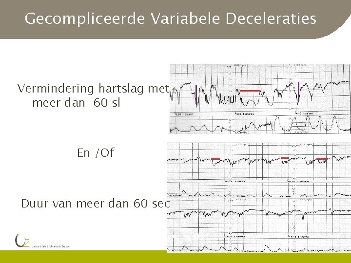 Gecompliceerde Variabele Deceleraties Vermindering hartslag met meer dan 60 sl En /Of Duur van