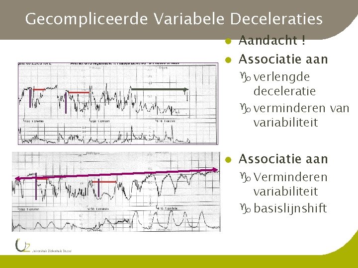 Gecompliceerde Variabele Deceleraties l l Aandacht ! Associatie aan g verlengde deceleratie g verminderen
