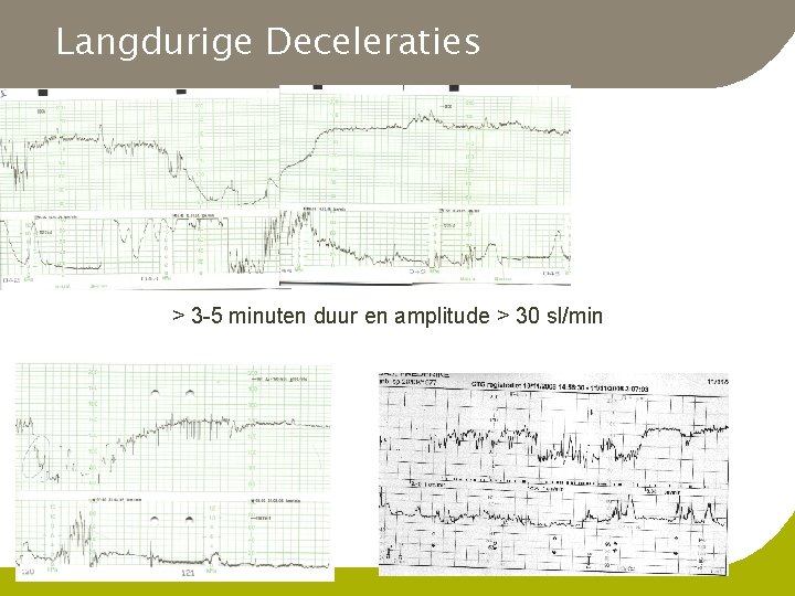 Langdurige Deceleraties > 3 -5 minuten duur en amplitude > 30 sl/min 