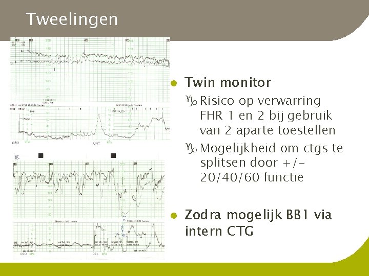 Tweelingen l Twin monitor g Risico op verwarring FHR 1 en 2 bij gebruik
