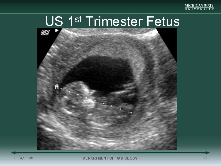 US 1 st Trimester Fetus 12/4/2020 DEPARTMENT OF RADIOLOGY 11 