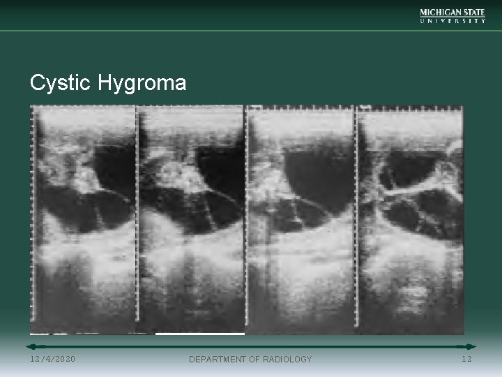 Cystic Hygroma 12/4/2020 DEPARTMENT OF RADIOLOGY 12 