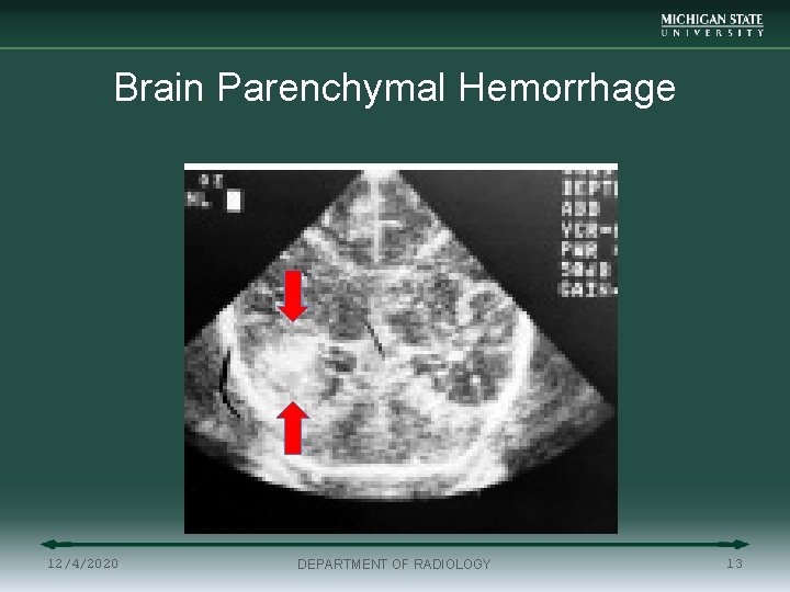Brain Parenchymal Hemorrhage 12/4/2020 DEPARTMENT OF RADIOLOGY 13 