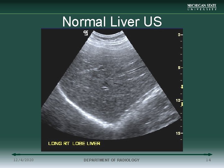 Normal Liver US 12/4/2020 DEPARTMENT OF RADIOLOGY 14 