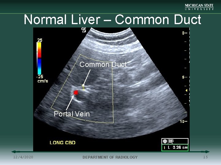 Normal Liver – Common Duct Portal Vein 12/4/2020 DEPARTMENT OF RADIOLOGY 15 