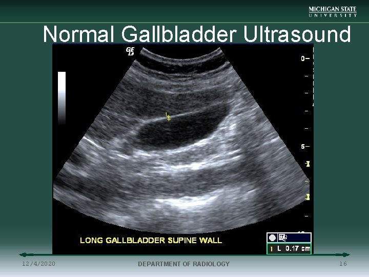Normal Gallbladder Ultrasound 12/4/2020 DEPARTMENT OF RADIOLOGY 16 