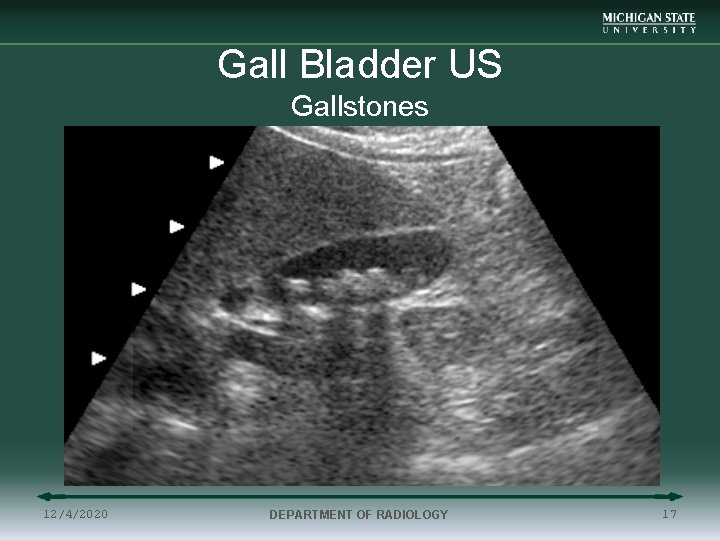Gall Bladder US Gallstones 12/4/2020 DEPARTMENT OF RADIOLOGY 17 