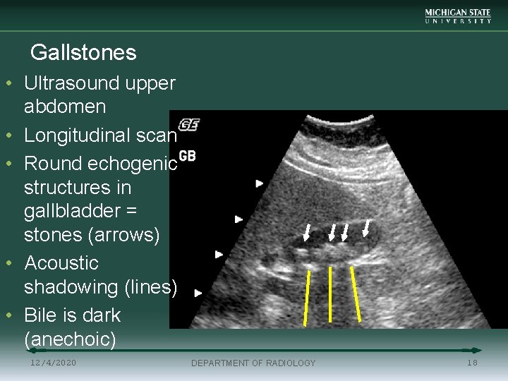 Gallstones • Ultrasound upper abdomen • Longitudinal scan • Round echogenic structures in gallbladder