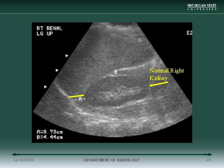 Normal Renal US Normal Right Kidney 12/4/2020 DEPARTMENT OF RADIOLOGY 19 