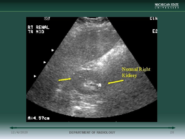 Normal Renal US Normal Right Kidney 12/4/2020 DEPARTMENT OF RADIOLOGY 20 