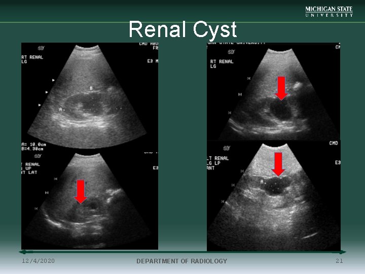Renal Cyst 12/4/2020 DEPARTMENT OF RADIOLOGY 21 