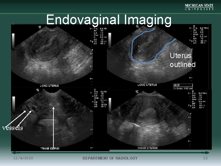 Endovaginal Imaging Uterus outlined vessels 12/4/2020 DEPARTMENT OF RADIOLOGY 22 