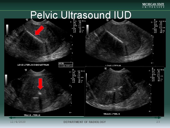 Pelvic Ultrasound IUD 12/4/2020 DEPARTMENT OF RADIOLOGY 23 