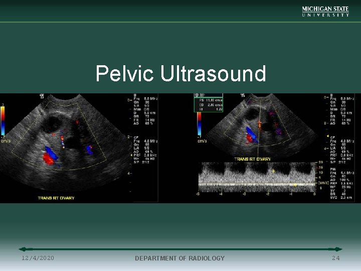 Pelvic Ultrasound 12/4/2020 DEPARTMENT OF RADIOLOGY 24 