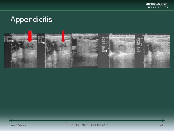 Appendicitis 12/4/2020 DEPARTMENT OF RADIOLOGY 26 
