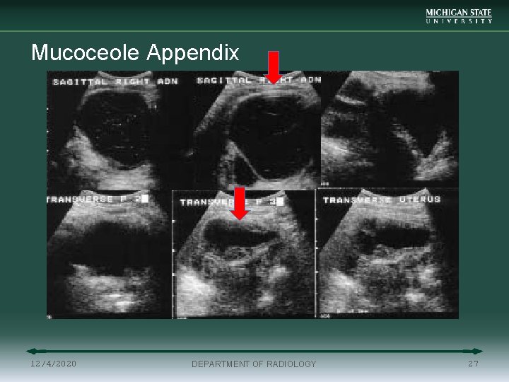 Mucoceole Appendix 12/4/2020 DEPARTMENT OF RADIOLOGY 27 
