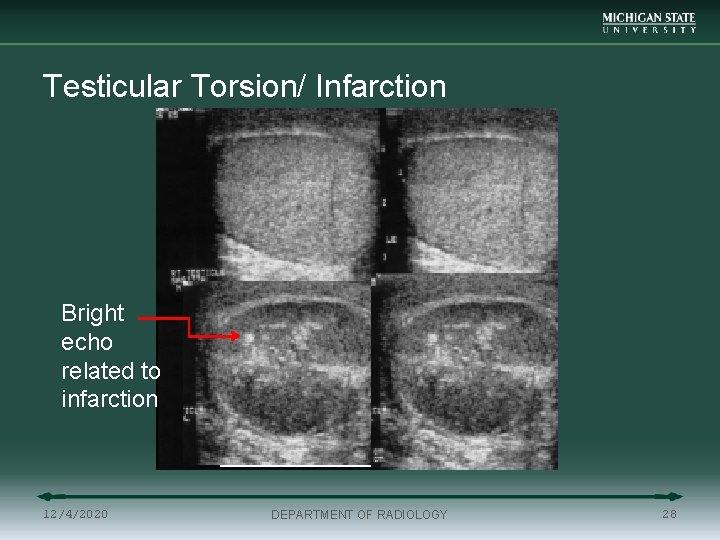 Testicular Torsion/ Infarction Bright echo related to infarction 12/4/2020 DEPARTMENT OF RADIOLOGY 28 
