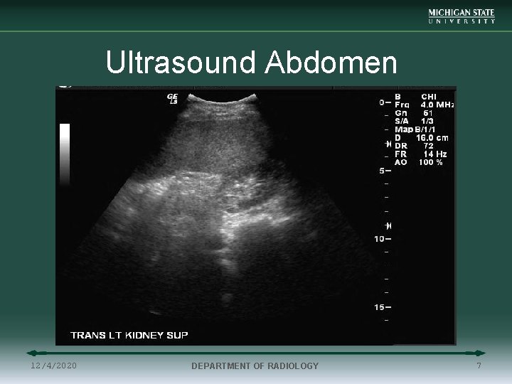 Ultrasound Abdomen 12/4/2020 DEPARTMENT OF RADIOLOGY 7 