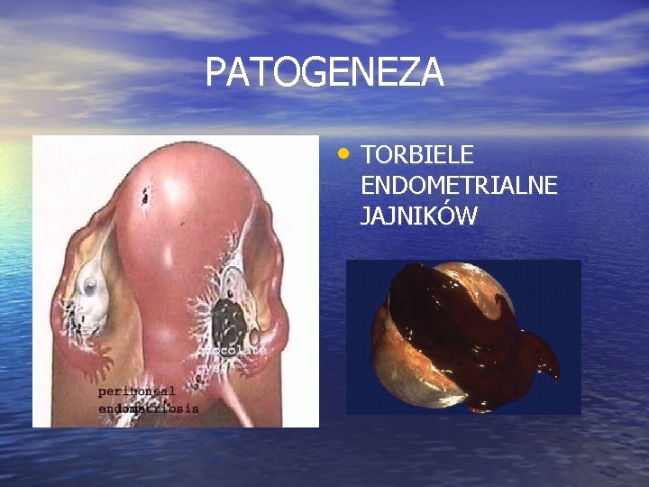 PATOGENEZA • TORBIELE ENDOMETRIALNE JAJNIKÓW 