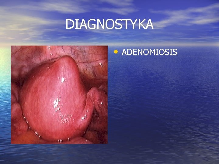 DIAGNOSTYKA • ADENOMIOSIS 