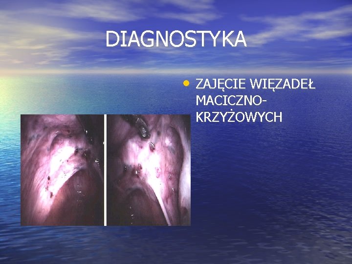 DIAGNOSTYKA • ZAJĘCIE WIĘZADEŁ MACICZNOKRZYŻOWYCH 