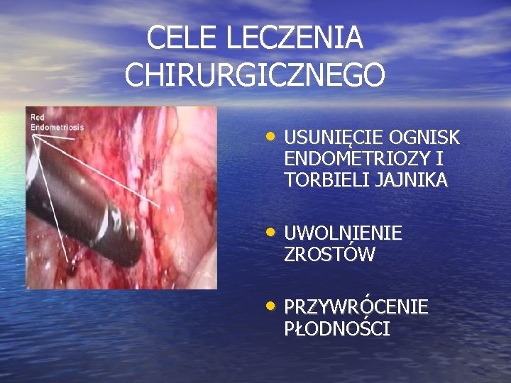 CELE LECZENIA CHIRURGICZNEGO • USUNIĘCIE OGNISK ENDOMETRIOZY I TORBIELI JAJNIKA • UWOLNIENIE ZROSTÓW •