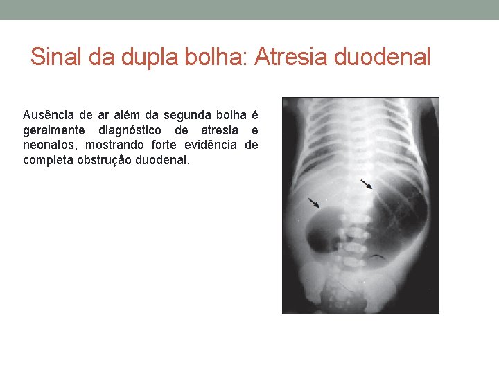 Sinal da dupla bolha: Atresia duodenal Ausência de ar além da segunda bolha é