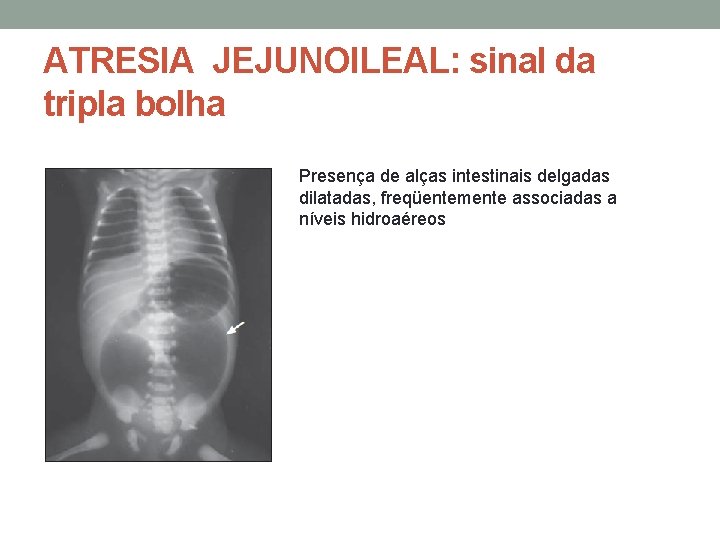 ATRESIA JEJUNOILEAL: sinal da tripla bolha Presença de alças intestinais delgadas dilatadas, freqüentemente associadas