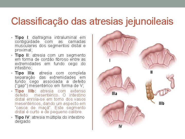 Classificação das atresias jejunoileais • Tipo I: diafragma intraluminal em • • contigüidade com