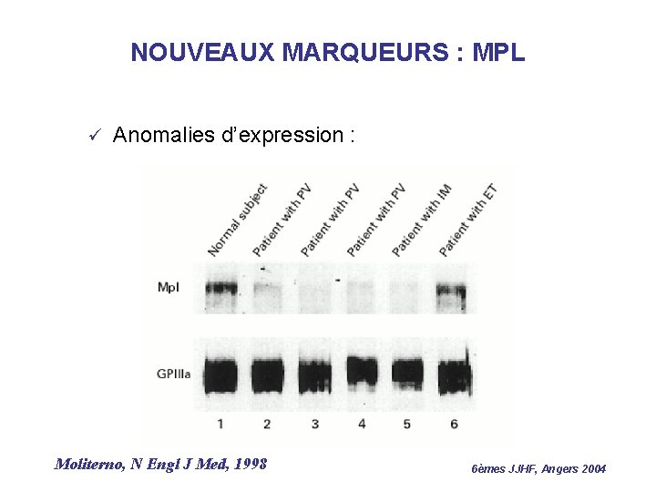 NOUVEAUX MARQUEURS : MPL ü Anomalies d’expression : Moliterno, N Engl J Med, 1998