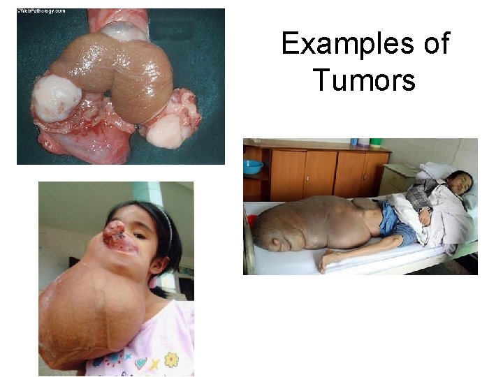 Examples of Tumors 